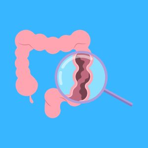 Cartoon graphic of a magnifying glass over a colonoscopy on a blue background.